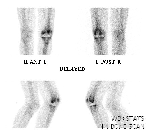 Bone Scan TKR 12 months Diffuse Uptake